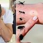 Calor y lluvias aumentan las picaduras de insectos: esta guía te ayuda a distinguir si fue un mosquito, una araña, una chinche, una pulga o una hormiga