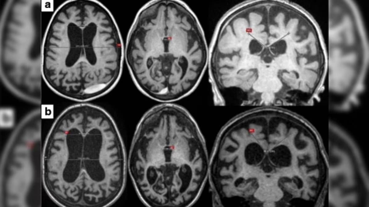 La terapia Avlayah es el primer avance en dos décadas capaz de actuar directamente en el cerebro en esta enfermedad genética. /researchgate.net