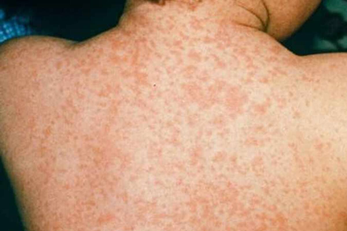 Departamento de salud alerta por brotes de sarampión en escuela de Florida