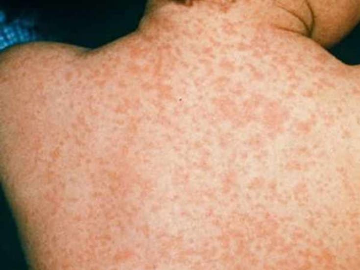 Sarampión en Puebla: Suben a 53 los casos confirmados en febrero de 2026 y autoridades refuerzan vacunación y vigilancia sanitaria