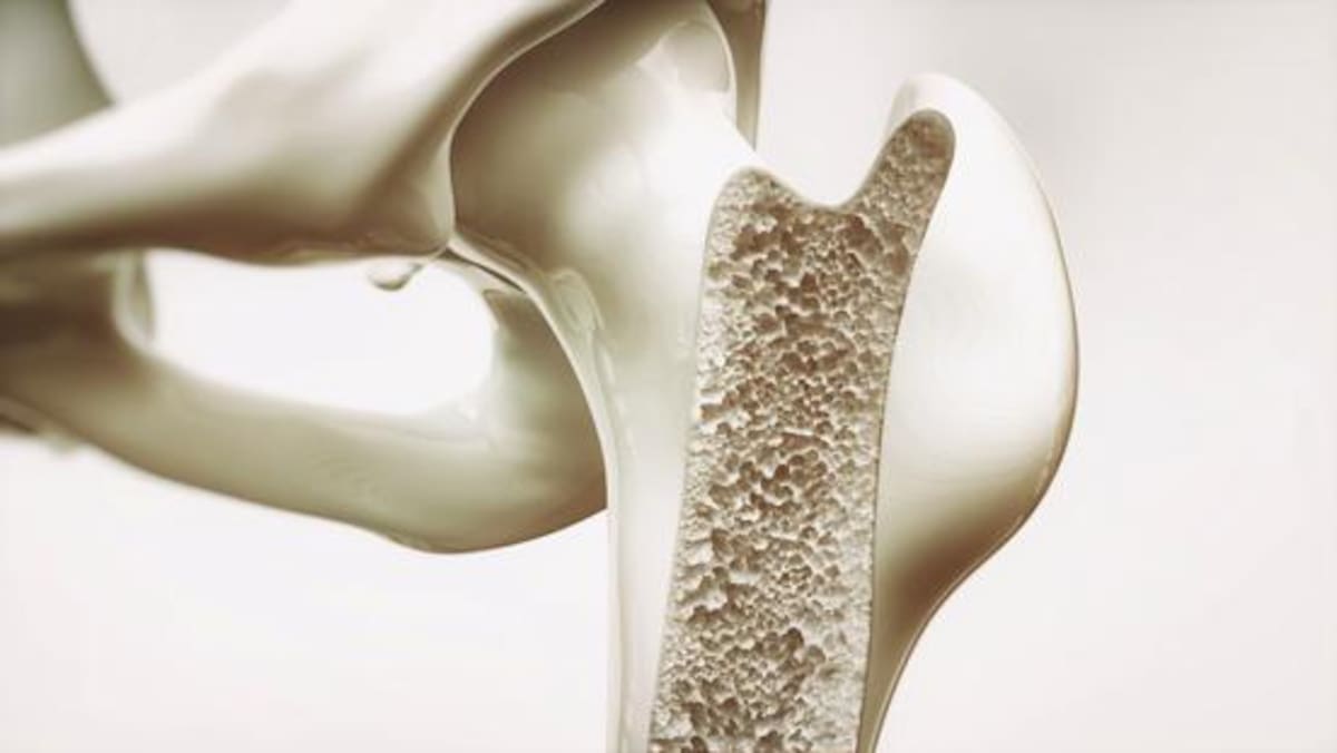 La osteoporosis es conocida por causar fragilidad ósea y aumentar el riesgo de fracturas.
