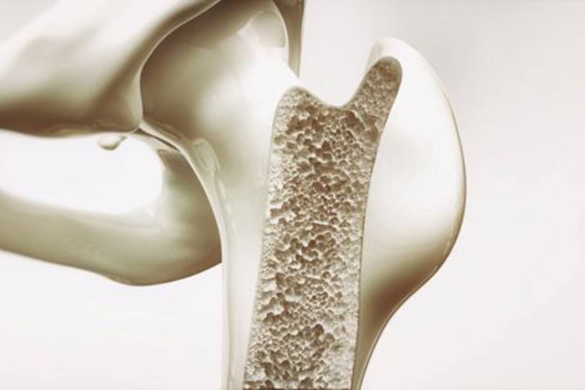 Descubren vínculo entre la melatonina y una rara forma de osteoporosis en jóvenes