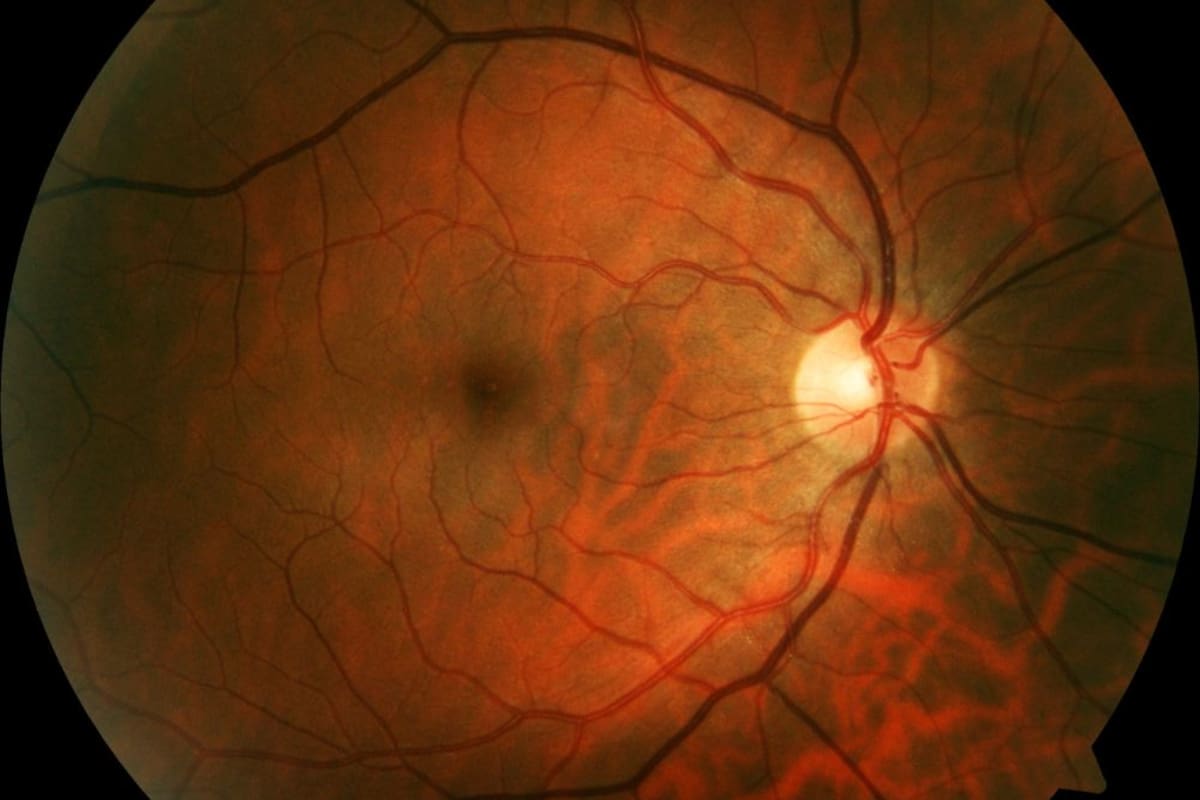 Un implante de retina inalámbrico restaura visión central en pacientes con degeneración macular avanzada
