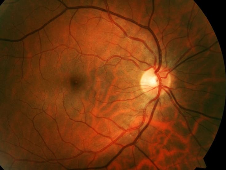 Un implante de retina inalámbrico restaura visión central en pacientes con degeneración macular avanzada