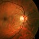 Un implante de retina inalámbrico restaura visión central en pacientes con degeneración macular avanzada