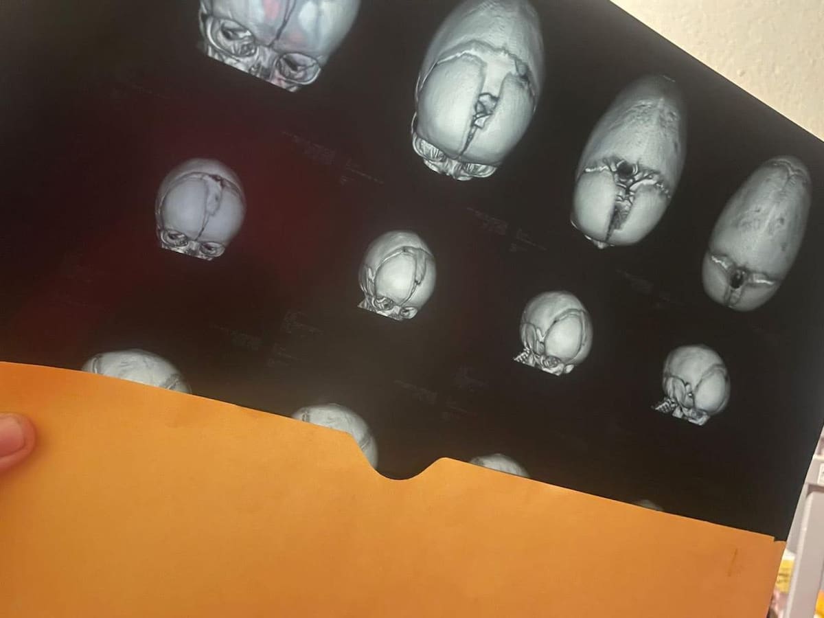 Elian, de 10 meses, necesita una segunda cirugía en septiembre para continuar con su tratamiento. Foto: Cortesía