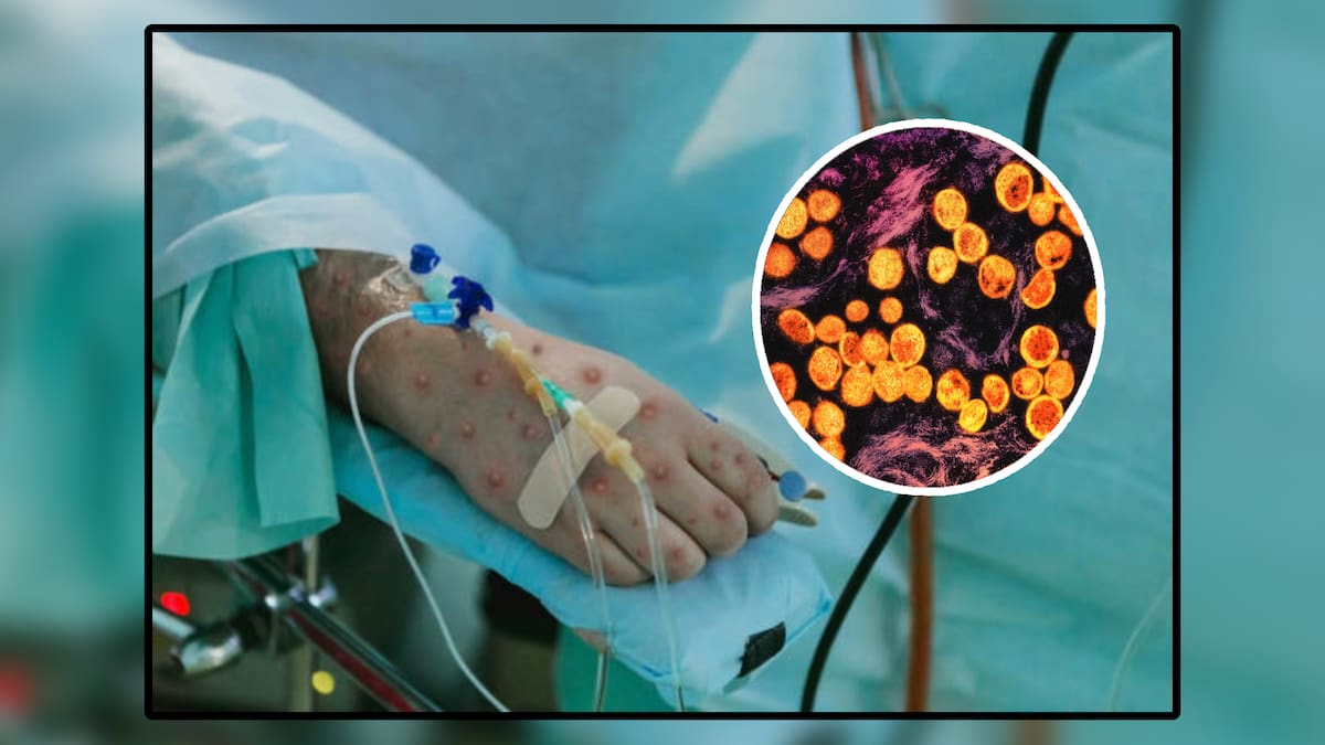 Mpox: ¿Qué es la viruela del mono, cómo se contagia y cuáles son sus síntomas y tratamiento? Foto: Especial