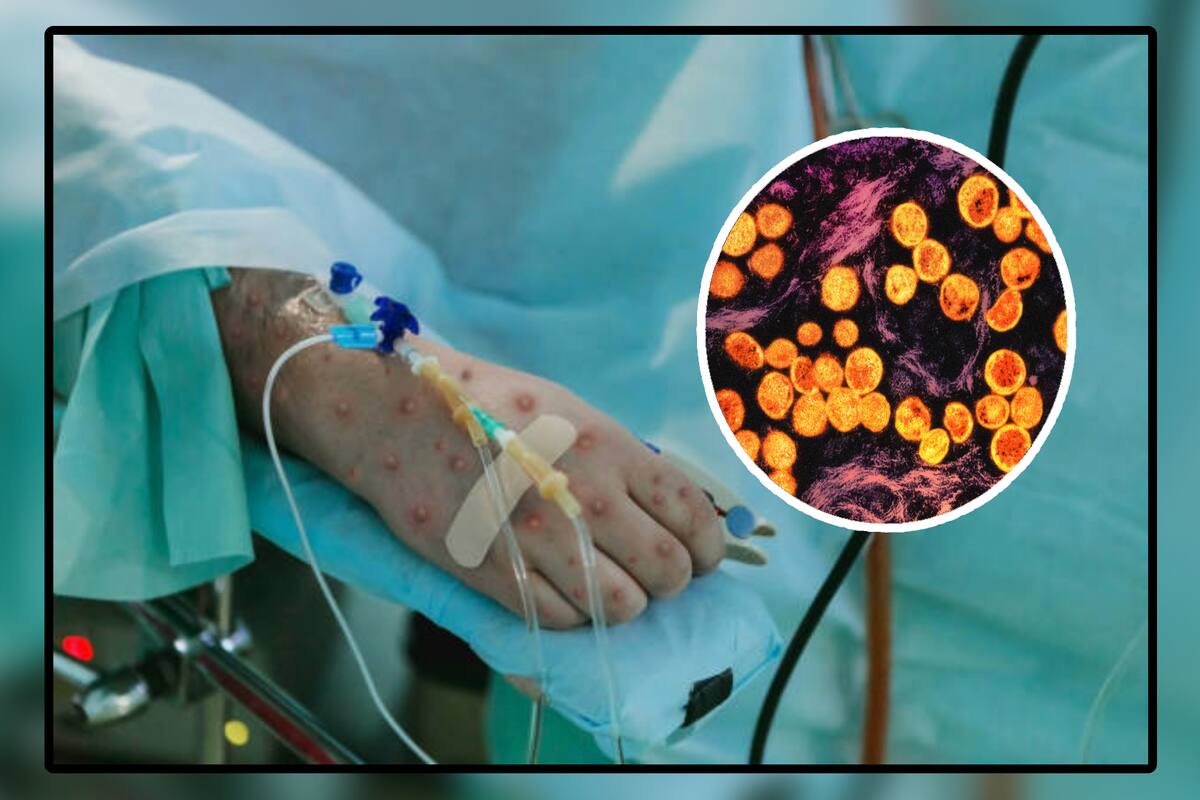 Mpox: ¿Qué es la viruela del mono, cómo se contagia y cuáles son sus síntomas y tratamiento?