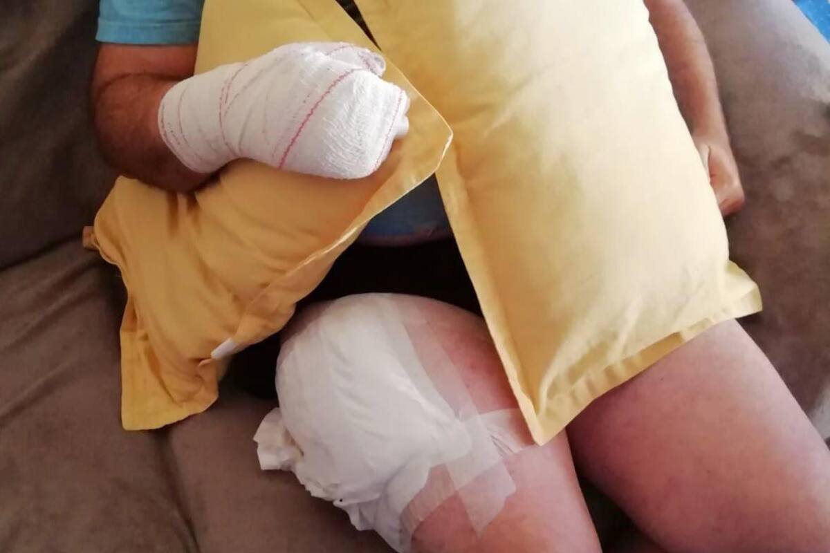 Sufre quemaduras al explotarle teléfono en pantalón