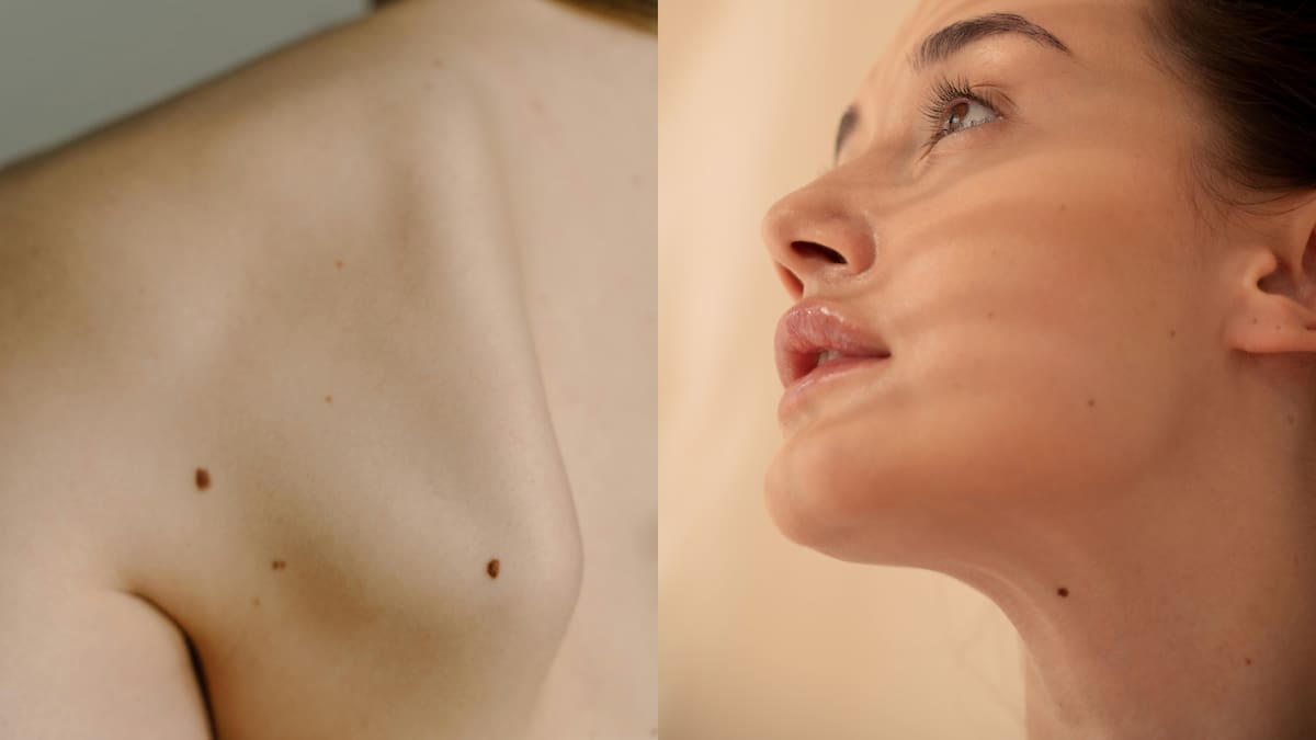 Conoce las diferencias entre melanoma y carcinoma sus señales de alerta, zonas donde aparecen y consejos para prevenir cáncer de piel