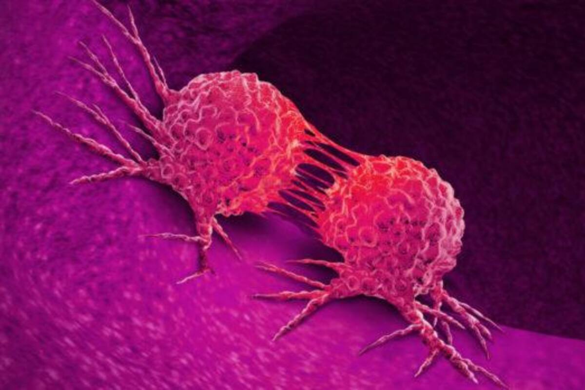 Día Mundial del Sarcoma: Signos y síntomas de los sarcomas de tejidos blandos