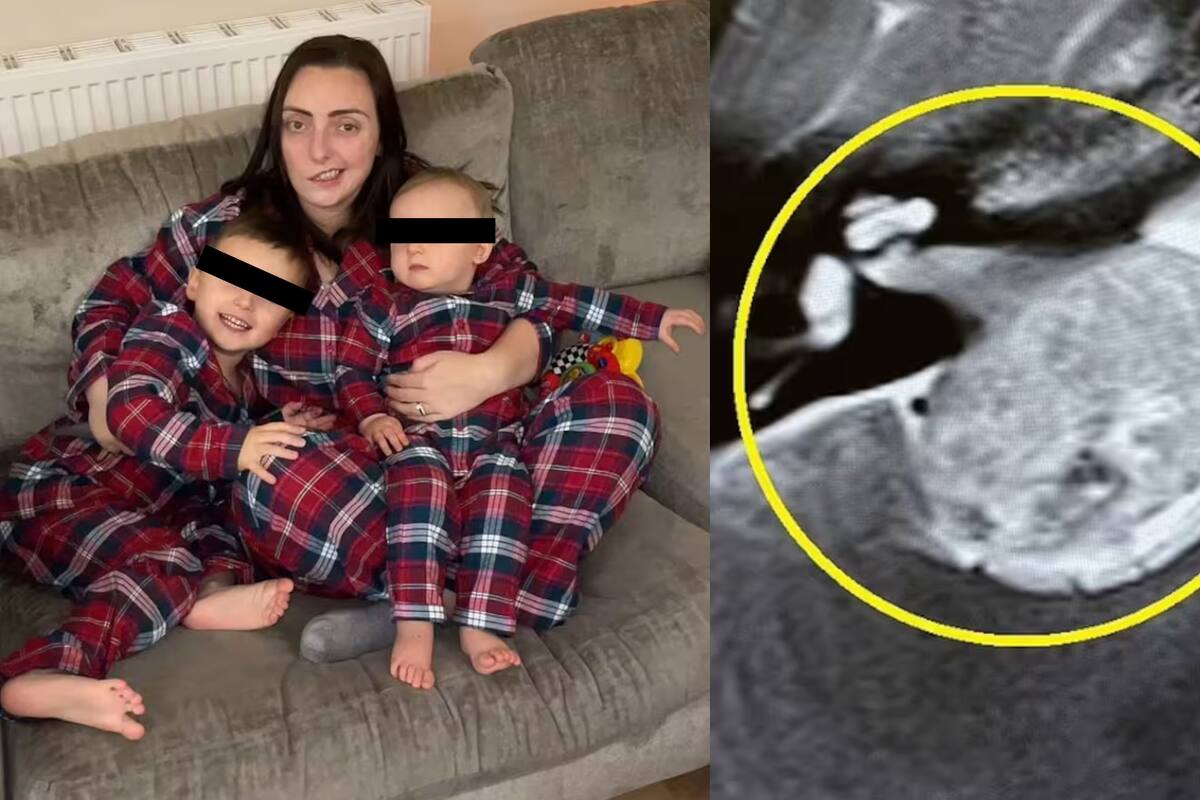 Mujer creyó que el estrés le causaba un tic en el ojo, pero resulto ser un tumor