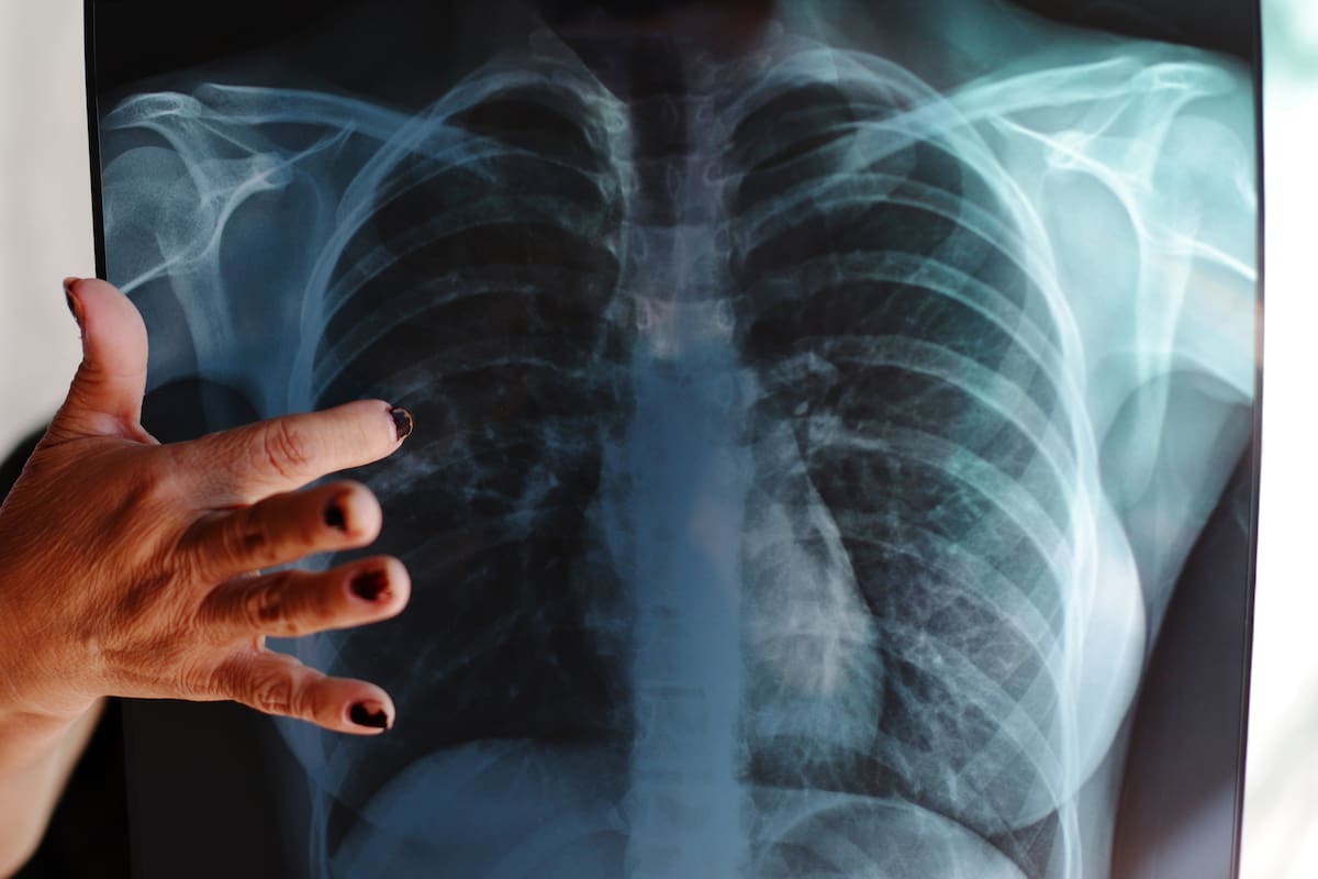 Ocupa BC primer lugar en casos nuevos de tuberculosis