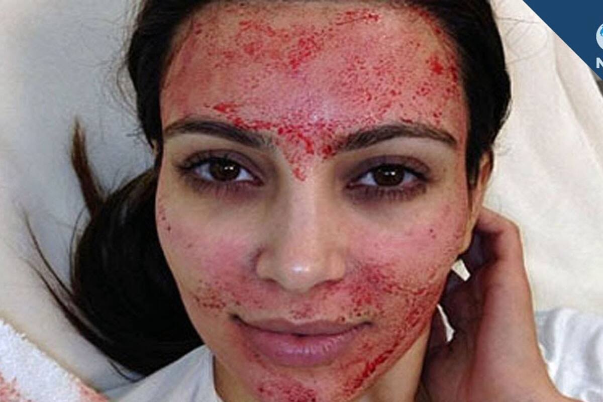 Se arrepiente Kim Kardashian de tratamiento con sangre centrifugada