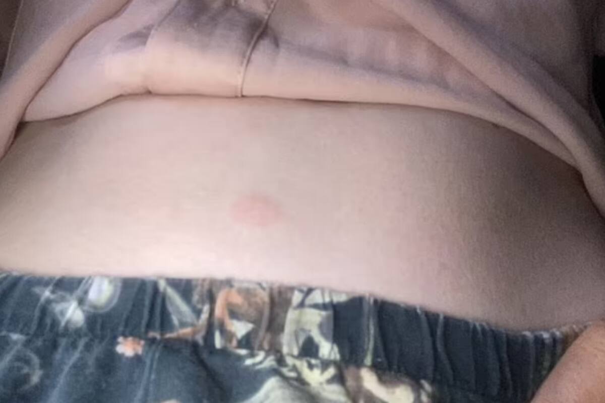 Mujer se aplica una inyección para eliminar grasa abdominal que compró en línea y casi muere