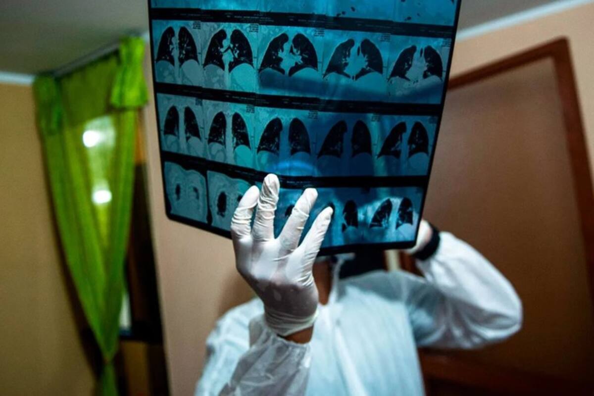 Coronavirus: cómo los pacientes excepcionales exponen los puntos débiles del SARS-CoV-2