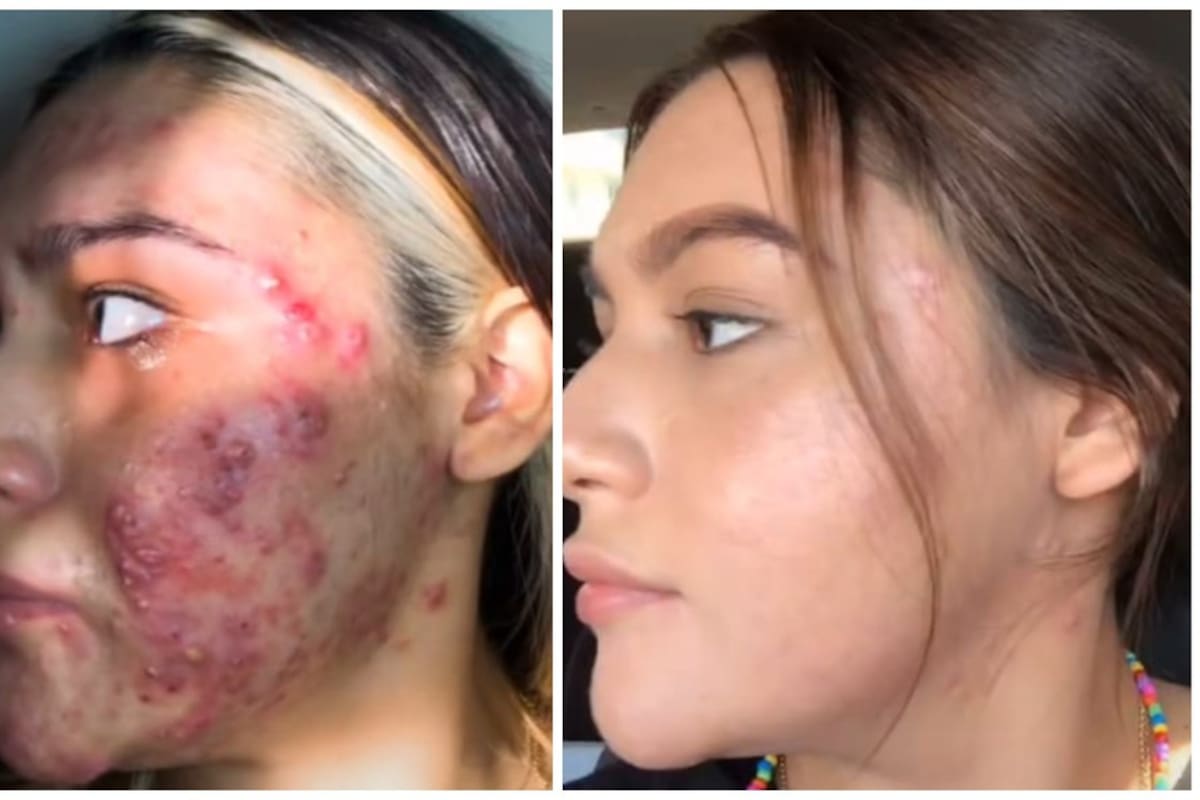 Joven comparte antes y después en su lucha contra el acné; video 'incendia' TikTok