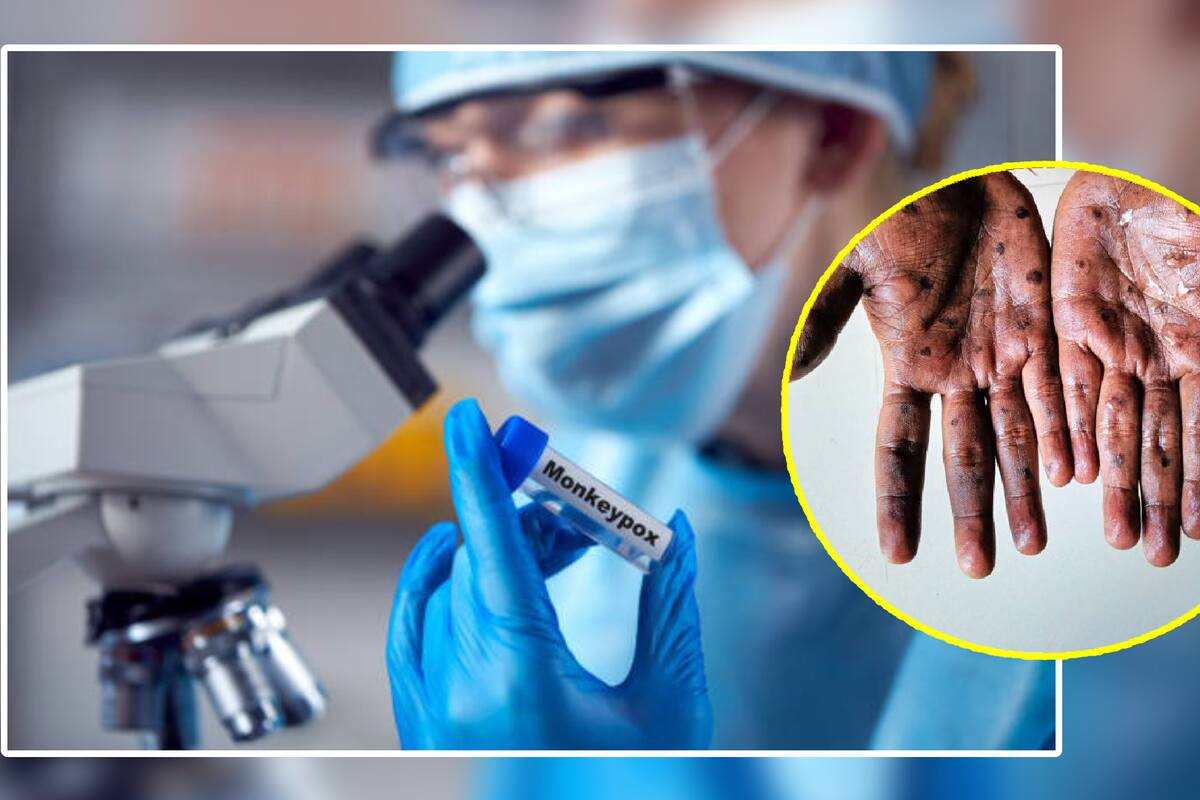 Este es el plan de la OMS para detener la viruela del mono: ¿Cuándo empieza?