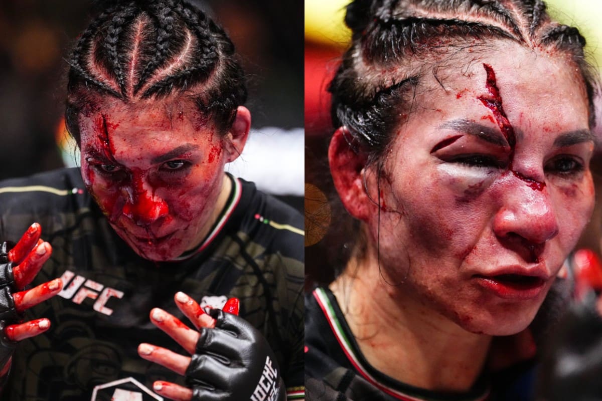 ¡Gran cambio! Así luce el rostro de Irene Aldana una semana después de su terrible cortada