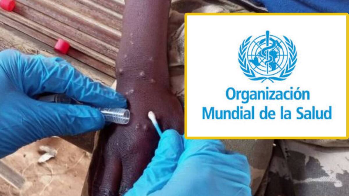 Mpox tiene varios síntomas entre ellos fiebre y erupción cutánea. Foto: Especial