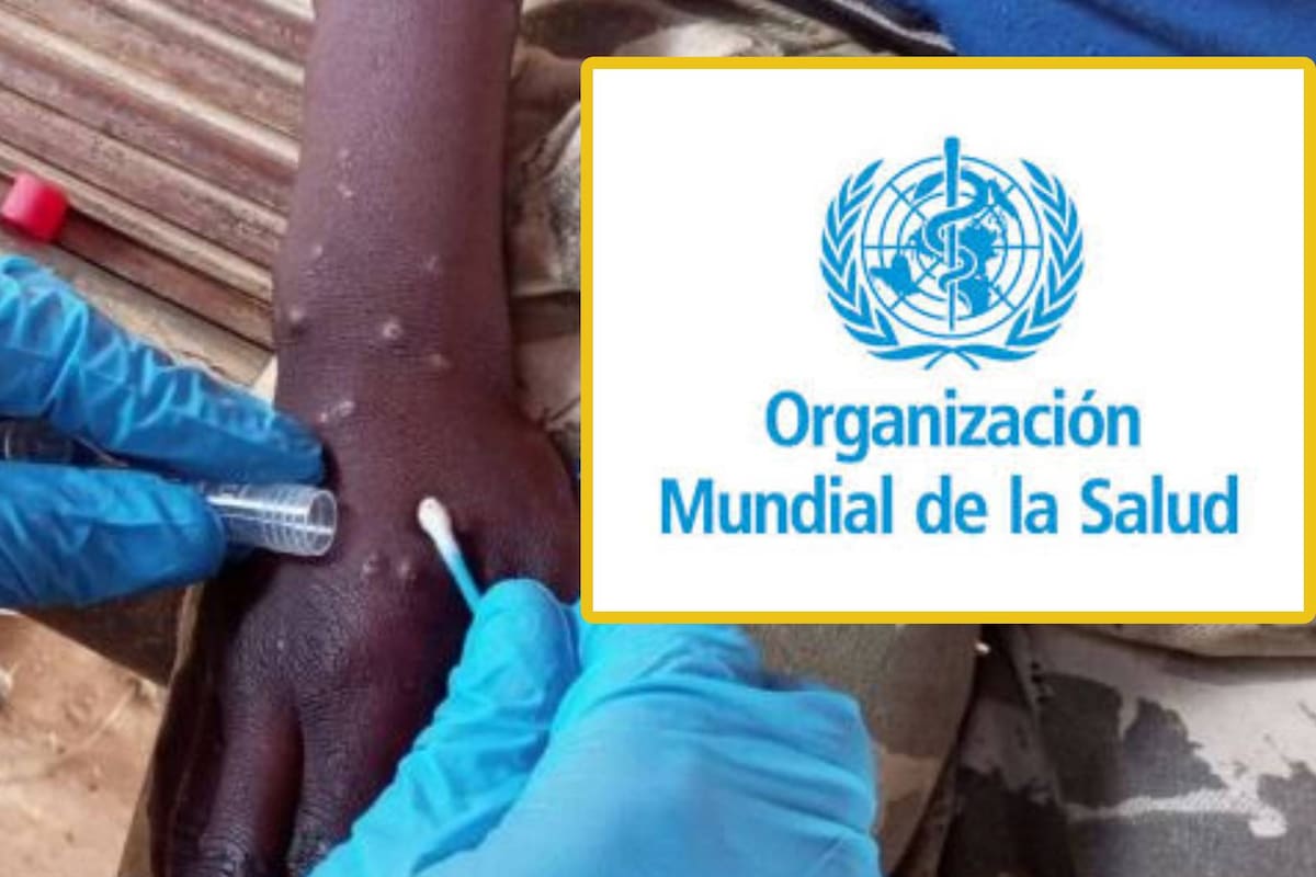 Mpox: ¿Se corre el riesgo de morir al contagiarse del virus?