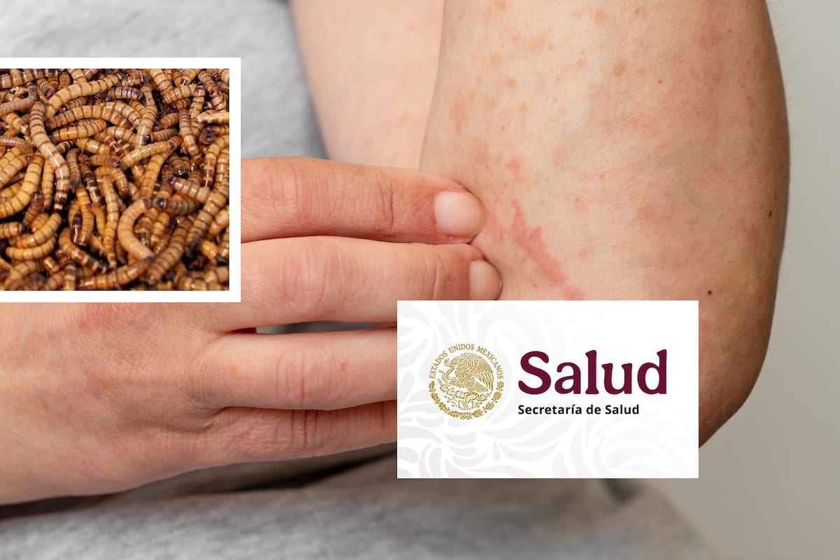 Detectan miasis, gusanos en la piel, en estos estados de México; suman seis casos