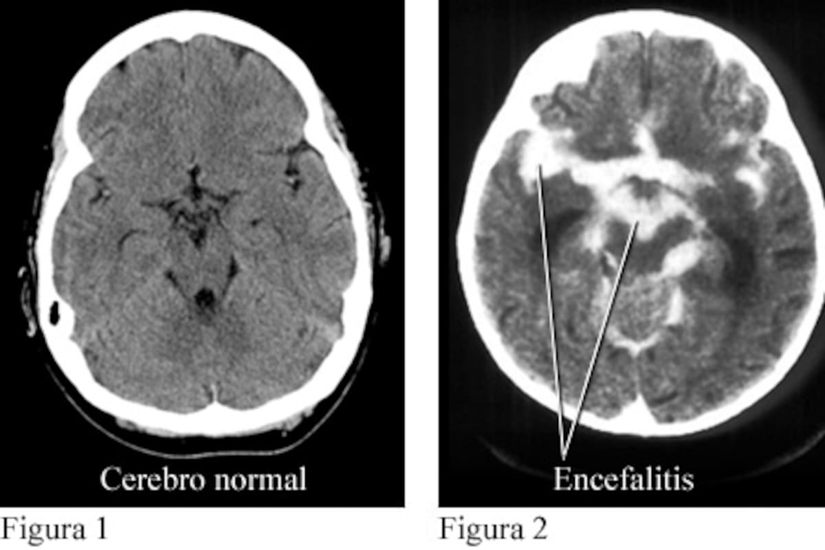 Día Mundial de la Encefalitis: Información y Concienciación sobre una Enfermedad Grave