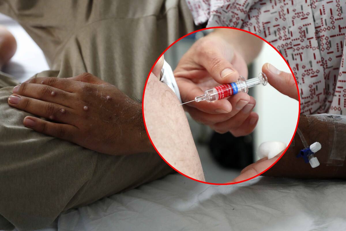 ¿Mpox solo se transmite con sexo? Viruela del mono, vacunación y prevención