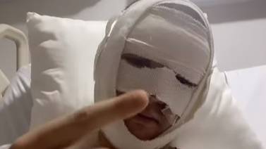 Omar Yubeili se quemó el rostro en terrible explosión de gas