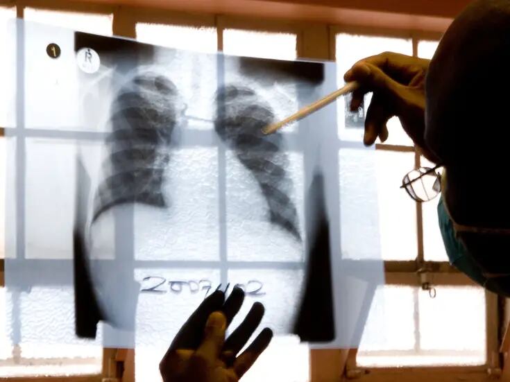 Aumento récord de casos de tuberculosis en EU en 2023