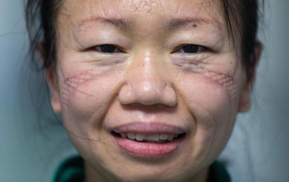 WUHAN, CHINA - FEBRUARY 17 2020: The marks of the mask are seen on the face of Nurse Cao Shan after working in the isolation ward in Jinyintan Hospital, designated for COVID-19 patients, in Wuhan in central China's Hubei province Monday, Feb. 17, 2020. She and her husband, a doctor also working at the hospital, have slept in the vehicle for 23 nights to avoid bringing viral hazards around, save commuting time, and give their assigned nearby hotel room to colleagues.