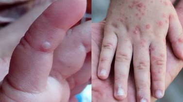 Virus Coxsackie: Infección mano, pie y boca es común en Sonora